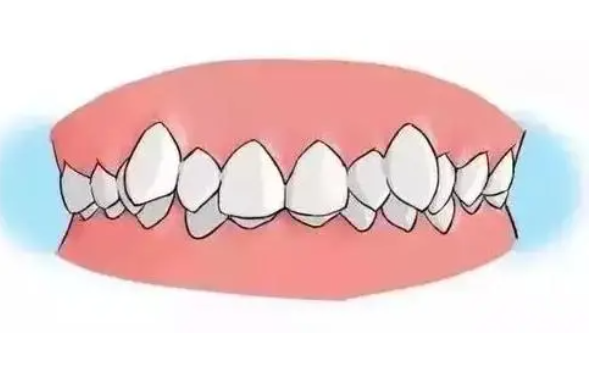 牙齿矫正4