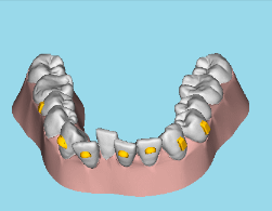 牙齿矫正2