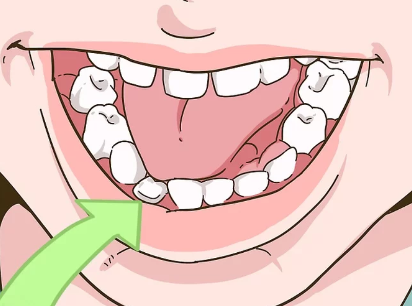How long should deciduous teeth be extracted?