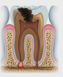 Tooth root inflammation is terrible