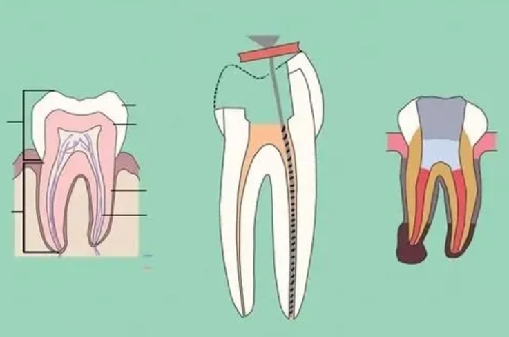 During root canal treatment, what did the doctor's drill wear away?