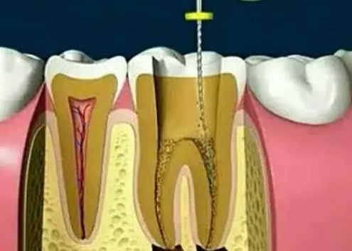 根管治疗2