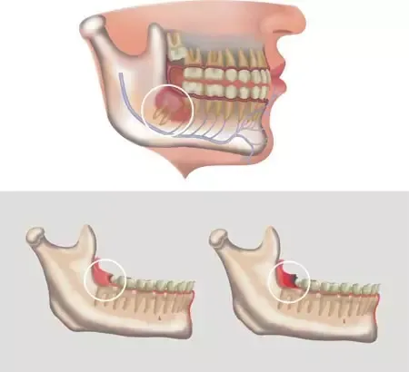 Zhuhai Wisdom Tooth Extraction: Do wisdom teeth need to be extracted even if they don't hurt?