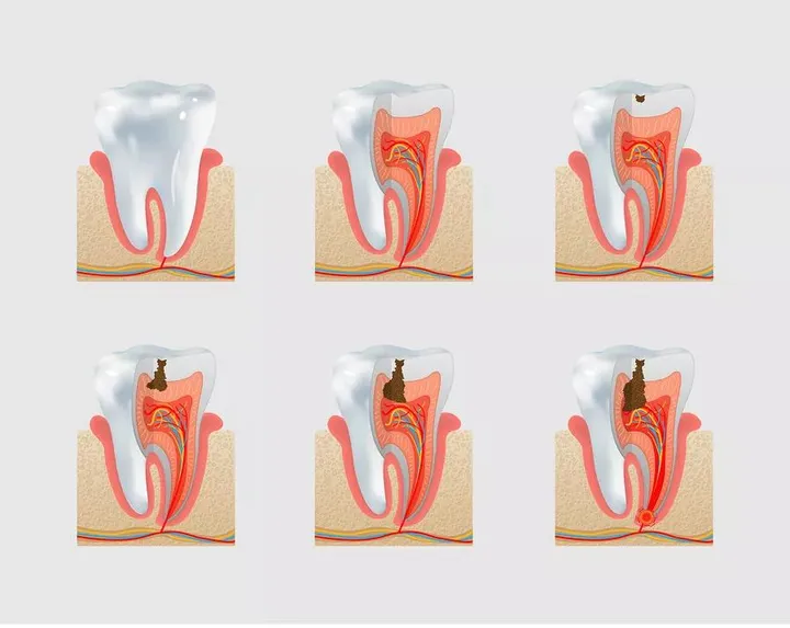 Cost of Filling in Zhuhai: How much is a reasonable cost of Tooth filling?