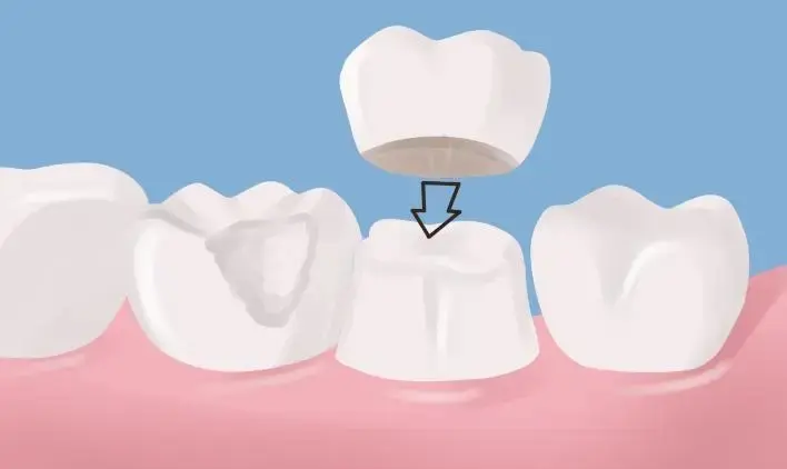 Zhuhai braces price: what material is good for braces and how much does it cost?