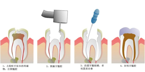 Macau root canal treatment Price: Where is the doctor who charges cheaply and has good results?