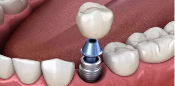 The tooth of Macau is minimally invasive dental implants