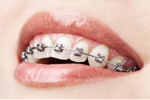 How much does it cost to get a brace in Macau? Frequently Asked Questions