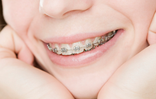 Macau Orthodontic Price 2024: Advantages of Choosing Vickong Dental and Reasons for Recommendation